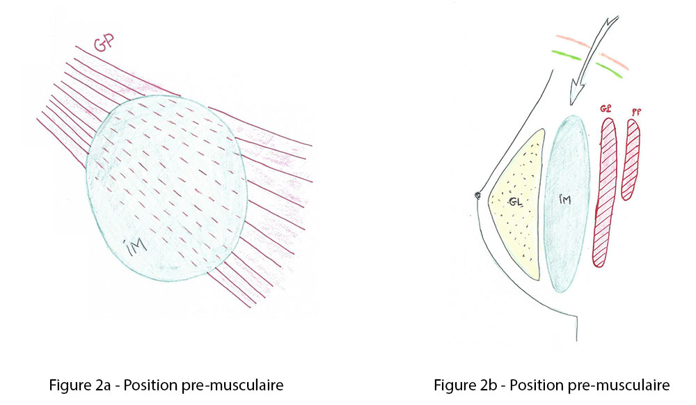 Figure 2a et 2b : position pre musculaire