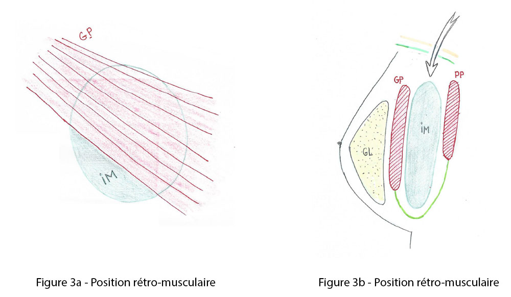 Figure 3a et 3b : position retro musculaire