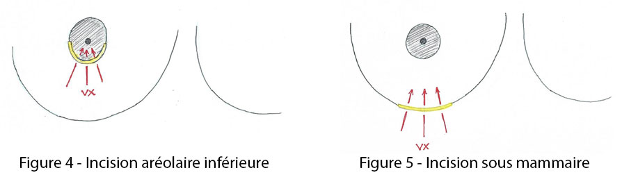 figure 4 et 5 : incision aréolaire inférieure incision sous mammaire