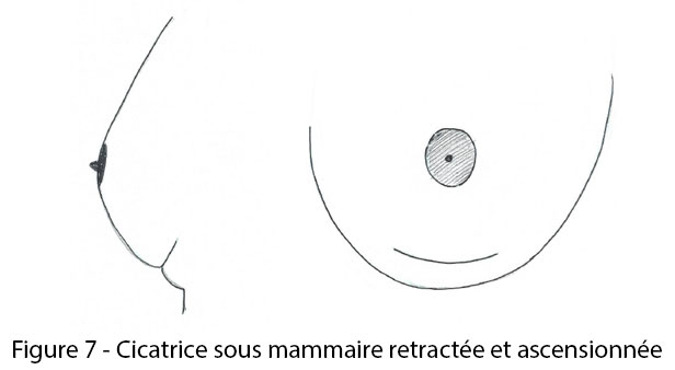 figure 7 : cicatrice sous mammaire rétractée et ascensionnée